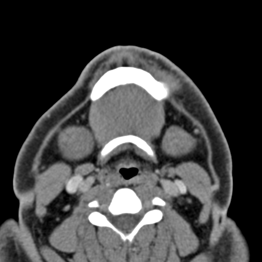 File:Ameloblastoma (Radiopaedia 33677-34806 Axial non-contrast 32).png