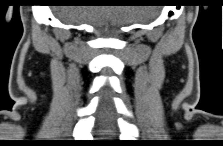 Ameloblastoma (Radiopaedia 33677-34806 Coronal non-contrast 55).png