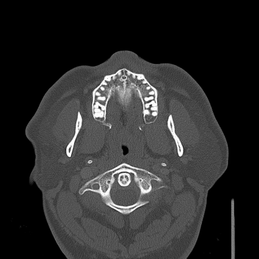 File:Ameloblastoma (Radiopaedia 33677-34806 Sagittal bone window 1).png