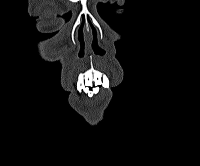 Ameloblastoma (Radiopaedia 51921-57766 Coronal bone window 7).jpg