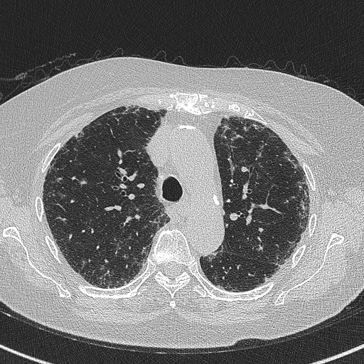 File:Amiodarone-induced pulmonary fibrosis (Radiopaedia 82355-96460 Axial lung window 23).jpg