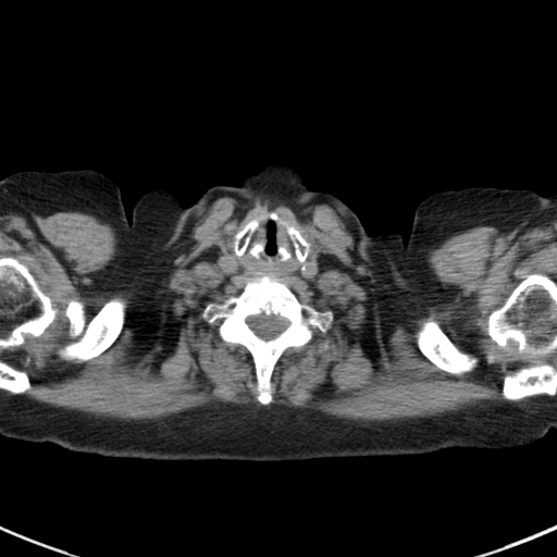 File:Amiodarone-induced pulmonary fibrosis (Radiopaedia 82355-96460 Axial non-contrast 3).jpg