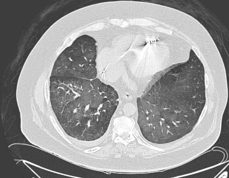 Amiodarone lung (Radiopaedia 62514-70769 Axial lung window 63).jpg
