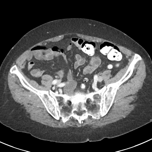 Ampullary adenocarcinoma (Radiopaedia 34013-35237 C 41).png