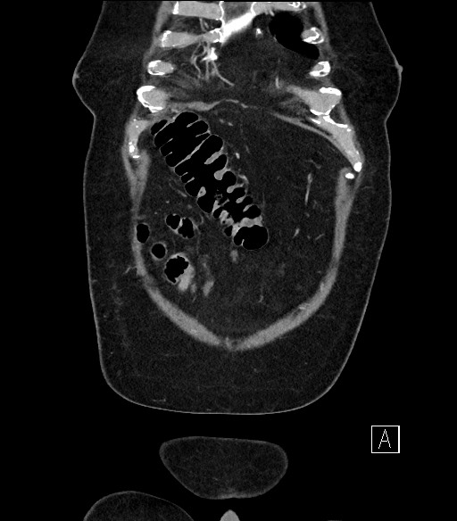 Ampullary adenocarcinoma (Radiopaedia 59373-66734 D 1).jpg