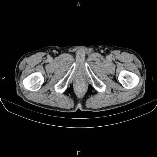 Ampullary adenocarcinoma (Radiopaedia 86093-102032 Axial C+ delayed 113).jpg