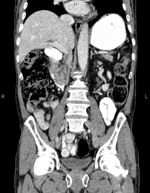 Ampullary adenocarcinoma (Radiopaedia 86093-102032 C 37).jpg