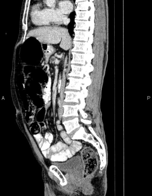 Ampullary adenocarcinoma (Radiopaedia 86093-102032 D 46).jpg