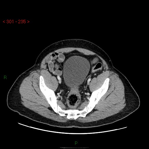 Ampullary carcinoma (Radiopaedia 56396-63056 C 84).jpg