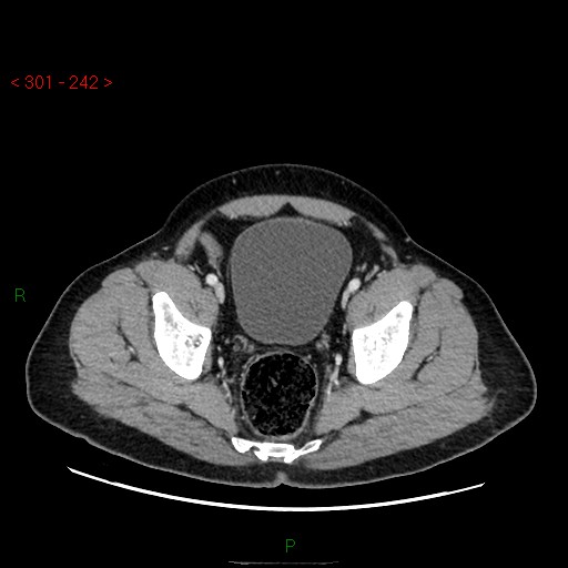 File:Ampullary carcinoma (Radiopaedia 56396-63056 C 89).jpg