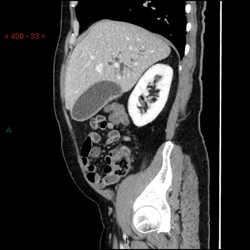 Ampullary carcinoma (Radiopaedia 56396-63056 D 32).jpg