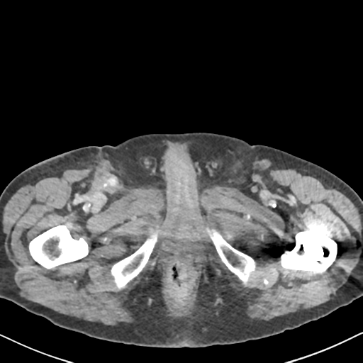 File:Amyand hernia (Radiopaedia 39300-41547 A 81).png