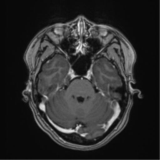 Anaplastic astroblastoma (Radiopaedia 55666-62194 Axial T1 C+ 22).png
