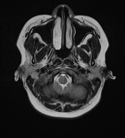 File:Anaplastic astroblastoma (Radiopaedia 55666-62194 Axial T2 3).png