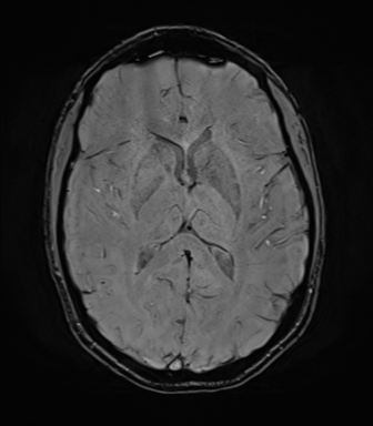 File:Anaplastic astrocytoma IDH mutant (Radiopaedia 50046-55341 Axial SWI 48).png