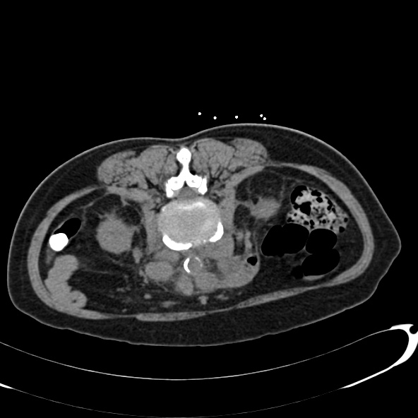 File:Anaplastic lymphoma - with CT biopsy (Radiopaedia 21643-21602 Axial non-contrast 40).jpg