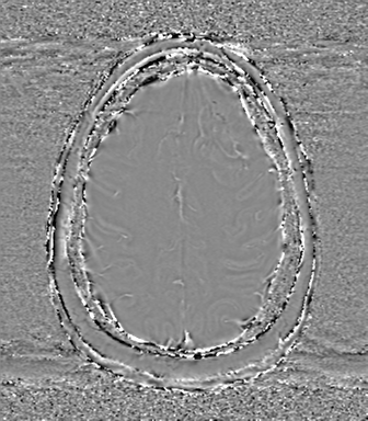 Anaplastic oligodendroglioma (Radiopaedia 83500-98599 Axial SWI - phase 66).png