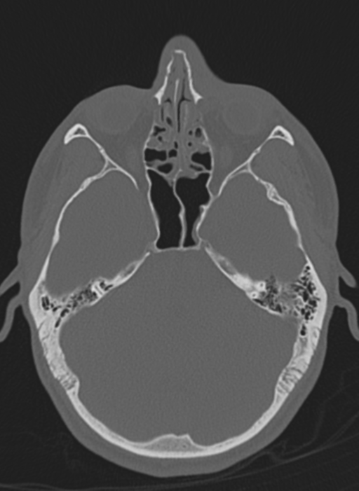 Anaplastic oligodendroglioma with skull fracture (Radiopaedia 74831-85846 Axial bone window 54).png