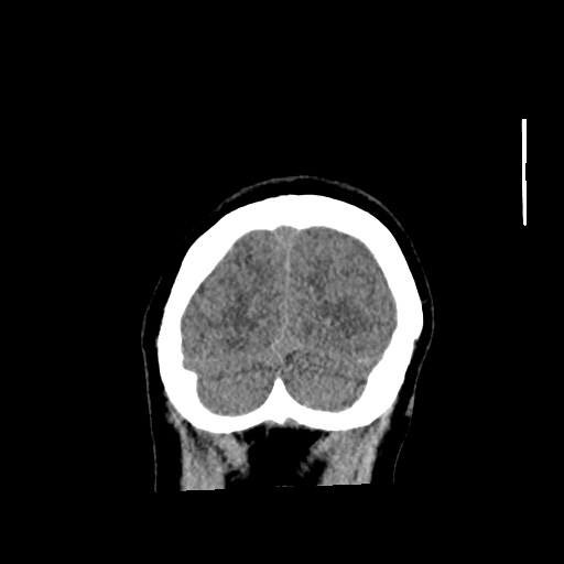Aneursym related subarachnoid hemorrhage with hydrocephalus (Radiopaedia 45105-49083 Coronal non-contrast 60).jpg