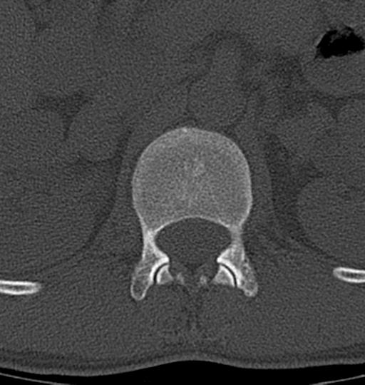 Aneurysmal bone cyst T11 (Radiopaedia 29294-29721 Axial bone window 61).jpg