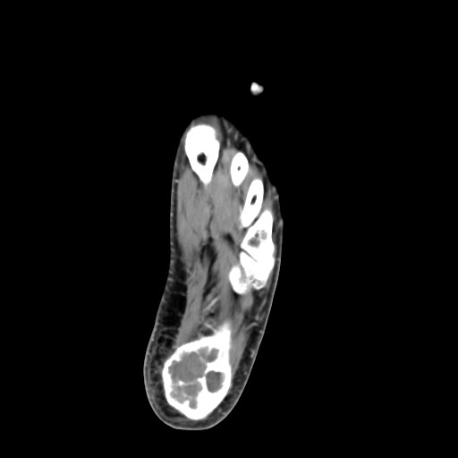 File:Aneurysmal bone cyst of the calcaneus (Radiopaedia 60669-68421 A 36).jpg