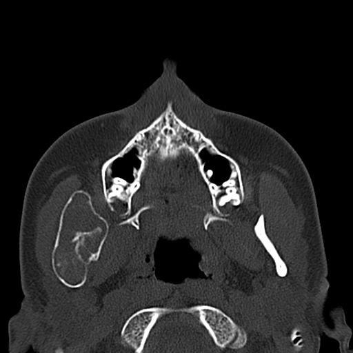 Aneurysmal bone cyst of the mandible (Radiopaedia 43280-46601 Axial bone window 54).jpg