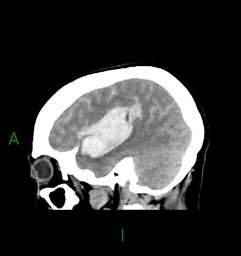 File:Aneurysmal subarachnoid hemorrhage with intra-axial extension (Radiopaedia 84371-99699 B 12).jpg
