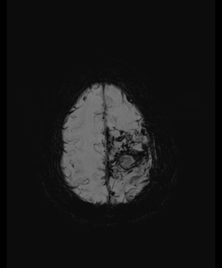 Angiomatous meningioma (Radiopaedia 79459-92579 E 55).jpg