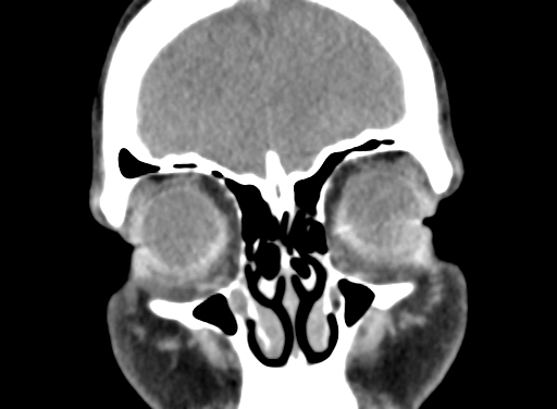 Angular dermoid cyst (Radiopaedia 88967-105790 Coronal non-contrast 18).jpg