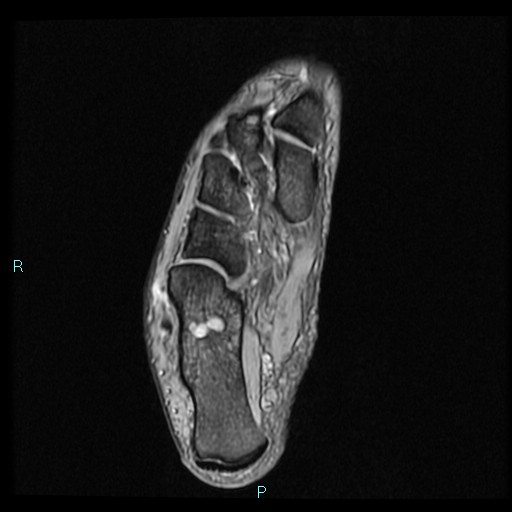 Ankle ganglion cyst (Radiopaedia 62809-71162 Axial Gradient Echo 24).jpg