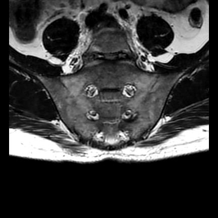 File:Ankylosing spondylitis with zygapophyseal arthritis (Radiopaedia 38433-40517 C 6).jpg