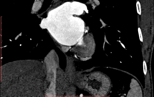 Anomalous left coronary artery from the pulmonary artery (ALCAPA) (Radiopaedia 70148-80181 B 211).jpg