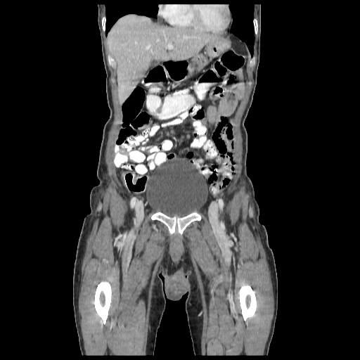 Anorectal carcinoma (Radiopaedia 44413-48064 B 14).jpg
