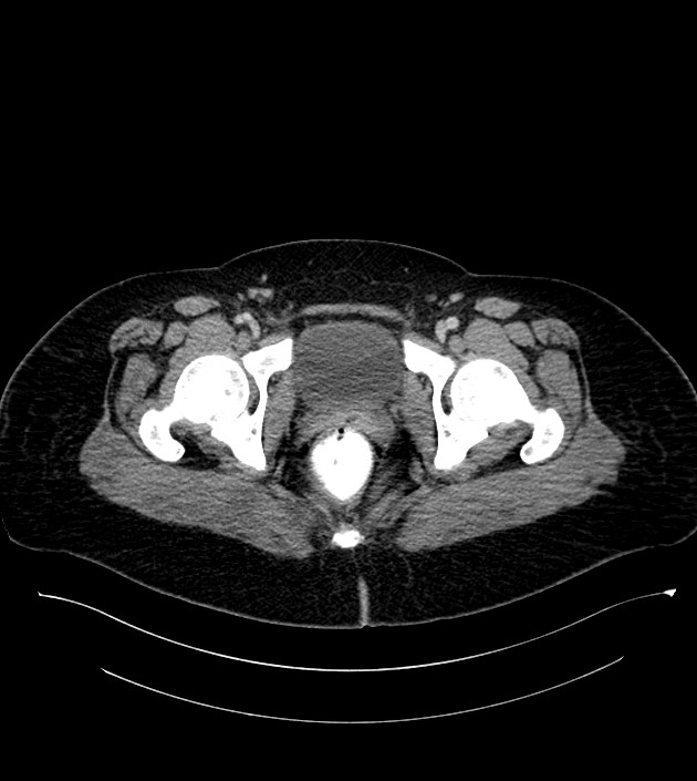 Anterior abdominal wall CSF pseudocyst (CSFoma) (Radiopaedia 79453-92571 A 89).jpg