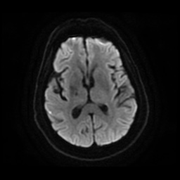 Anterior cerebral artery infarction (Radiopaedia 46794-51323 Axial DWI 16).jpg