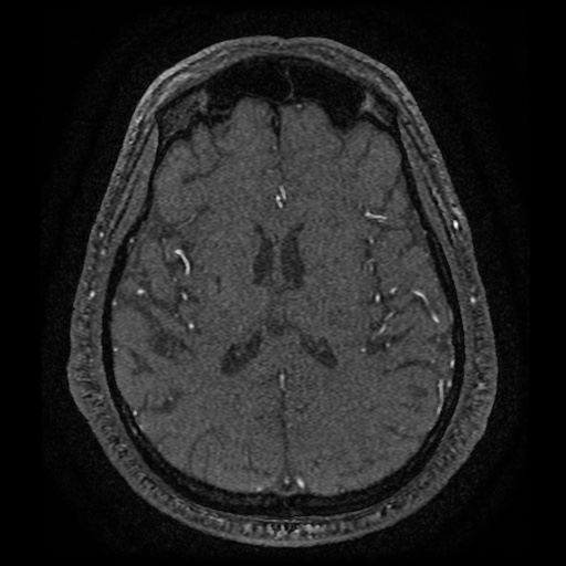 Anterior cerebral artery infarction (Radiopaedia 46794-51323 Axial MRA 126).jpg