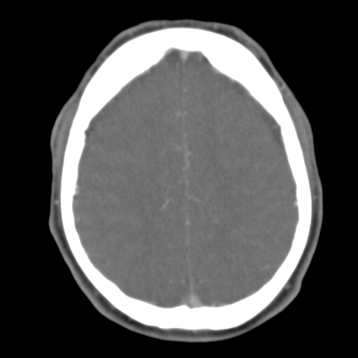 File:Anterior cerebral artery territory infarct (Radiopaedia 39327-41581 B 19).png