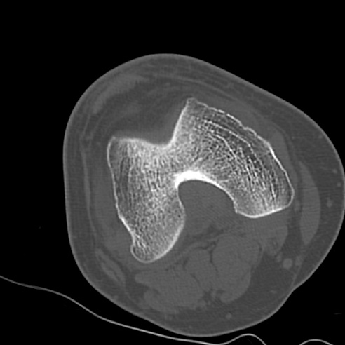 File:Anterior cruciate ligament avulsion fracture (Radiopaedia 58939-66194 Axial bone window 9).jpg