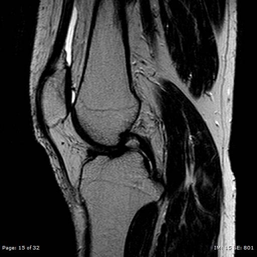 File:Anterior cruciate ligament tear (Radiopaedia 70783-80964 Sagittal T2 15).jpg