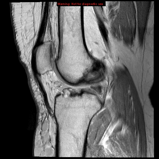 File:Anterior cruciate ligament tear - complete (Radiopaedia 12175-12514 Sagittal PD 10).jpg