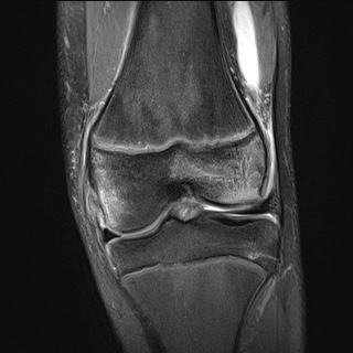 File:Anterior cruciate ligament tear - pediatric (Radiopaedia 62152-70260 Coronal PD fat sat 14).jpg