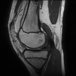 File:Anterior cruciate ligament tear - pediatric (Radiopaedia 62152-70260 Sagittal PD 63).jpg