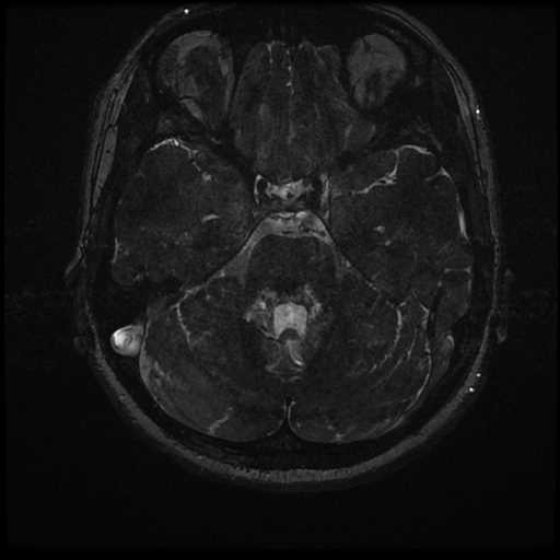 Anterior inferior cerebellar artery vascular loop - type II (Radiopaedia 70991-81209 Axial 3D FIESTA 7).jpg