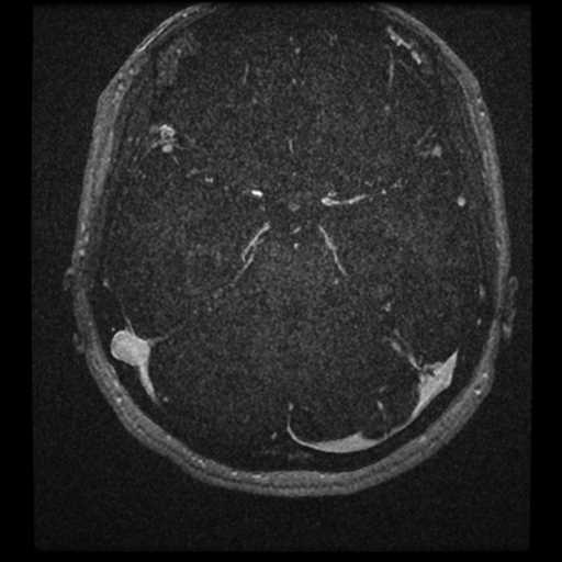 Anterior inferior cerebellar artery vascular loop - type II (Radiopaedia 70991-81209 Axial T1 C+ 3).jpg