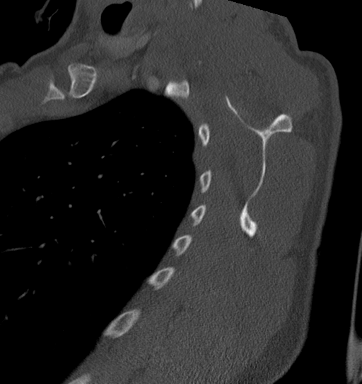 Anterior shoulder dislocation with Hill-Sachs and bony Bankart lesions (Radiopaedia 40424-42974 Sagittal bone window 43).png
