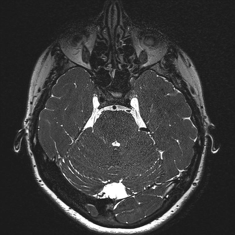 Anterior temporal encephalocele (Radiopaedia 82624-96808 Axial T2 high res 47).jpg