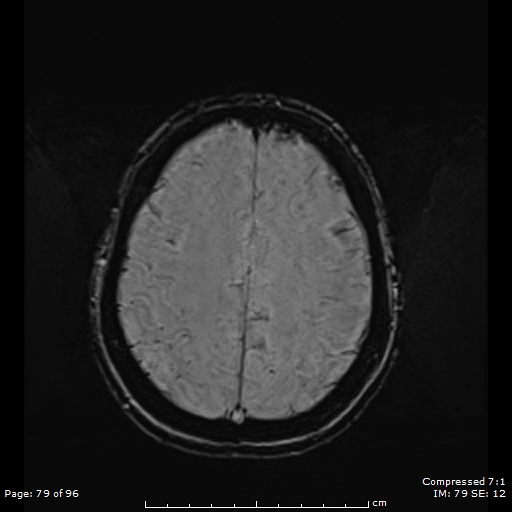 File:Anterior temporal lobe perivascular space (Radiopaedia 88283-104914 Axial SWI 48).jpg