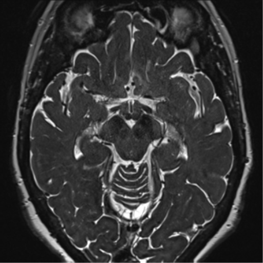 Anterior temporal pole cysts (Radiopaedia 46629-51102 Axial 56).png