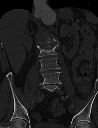 Anterior vertebral scalloping (abdominal aortic aneurysm) (Radiopaedia 66744-76067 Coronal bone window 29).jpg