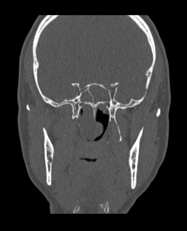 Antrochoanal polyp (Radiopaedia 79011-92169 Coronal bone window 24).jpg